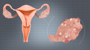 Polycystic_Ovaries-Disorder-Profile