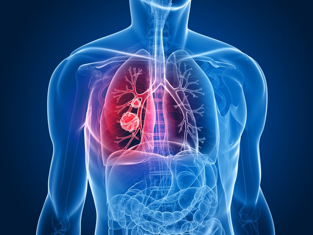 lung-cancer-banner-bg